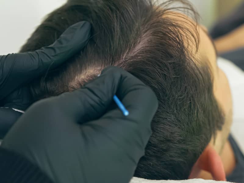 Scalp Micro Pigmentation (SMP) Course