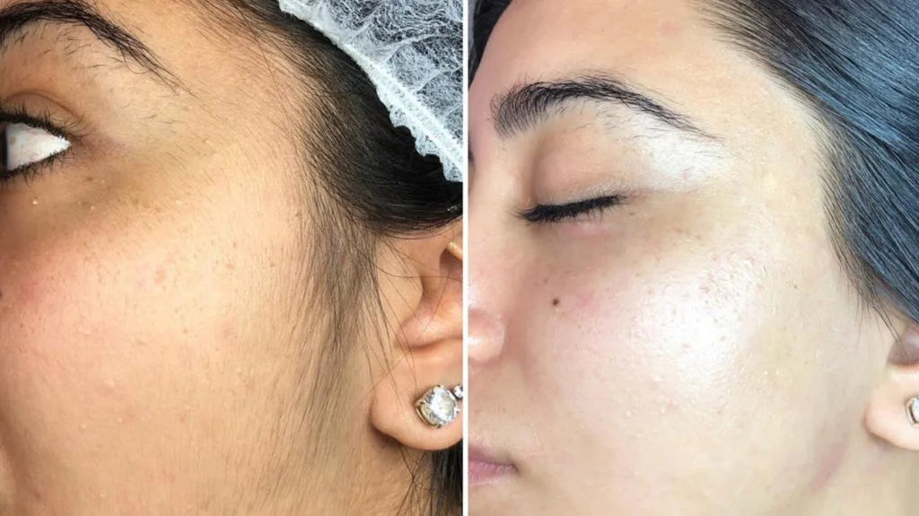 Advanced Dermaplaning Training Course
