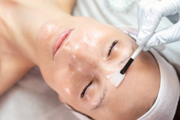 Chemical Peels Training Course