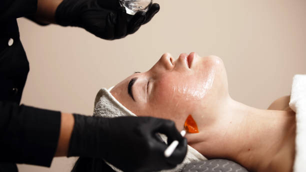 The Perfect Derma Peel Training Course